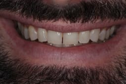 dull teeth
