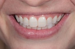 Teeth Whitening
