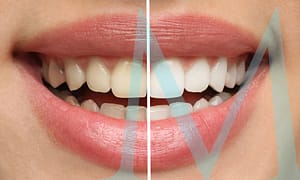 Get help for stained teeth.
