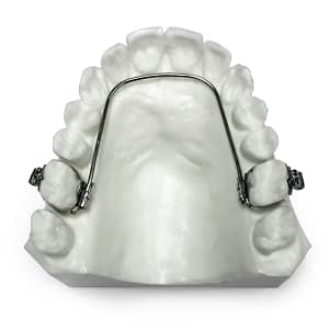 Fixed Lingual Controlled Arch