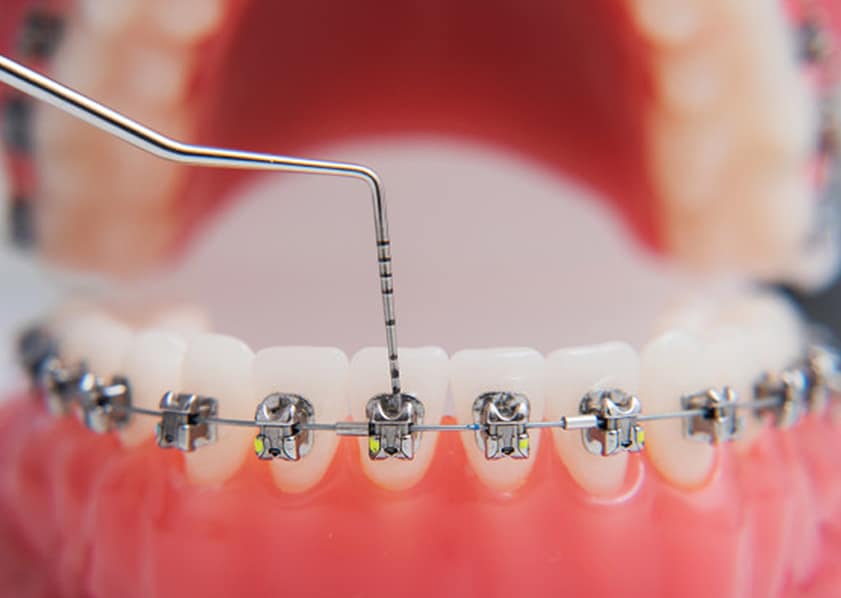 basic-course Straight Wire Orthodontic Bracket and Wire Example