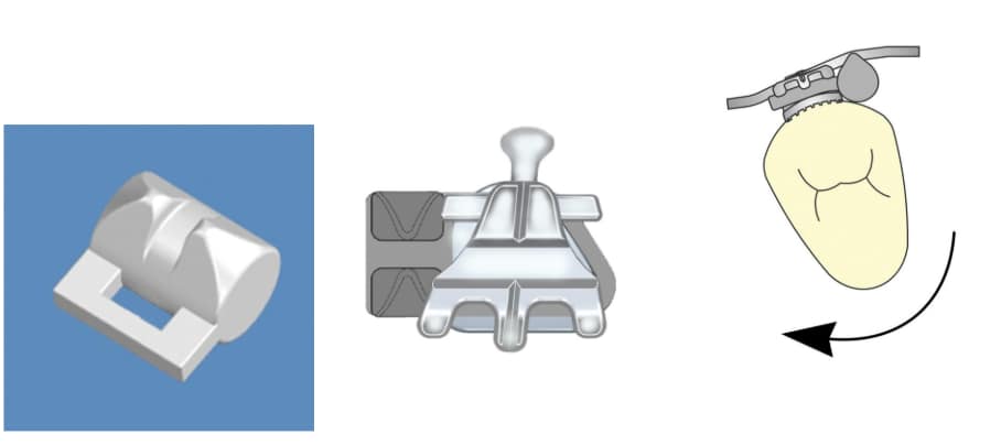 Delta Wing/SLB Rotation Wedges - Ortho Arch